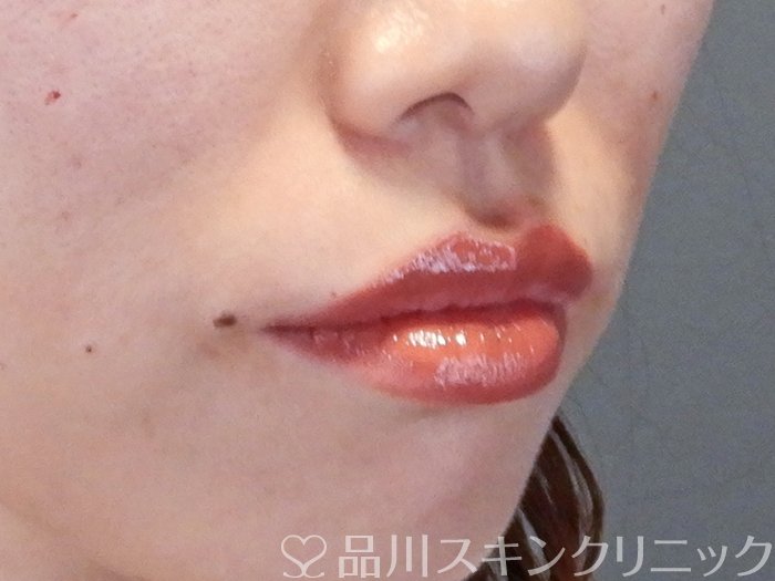 症例NO.65348のAFTER写真