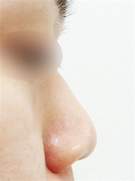 症例NO.16569のBEFORE写真