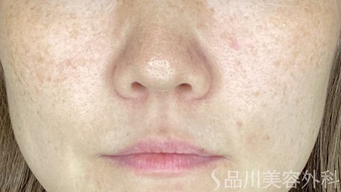 症例NO.67615のBEFORE写真