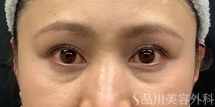 症例NO.65356のAFTER写真