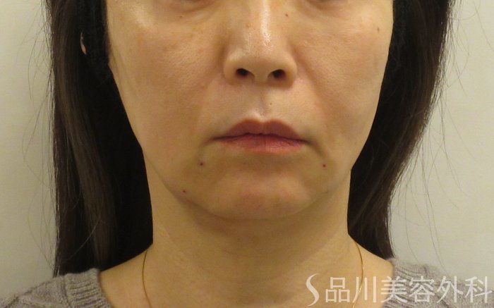 症例NO.72764のAFTER写真