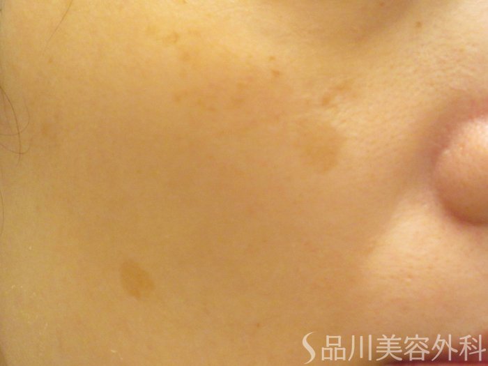 症例NO.74337のBEFORE写真