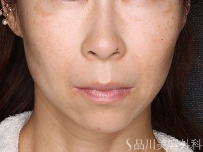 症例NO.72022のAFTER写真