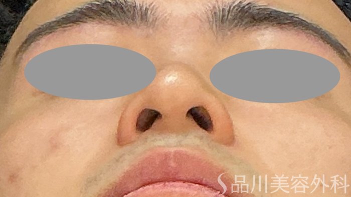 症例NO.71803のBEFORE写真