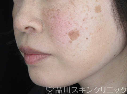 症例NO.70043のBEFORE写真