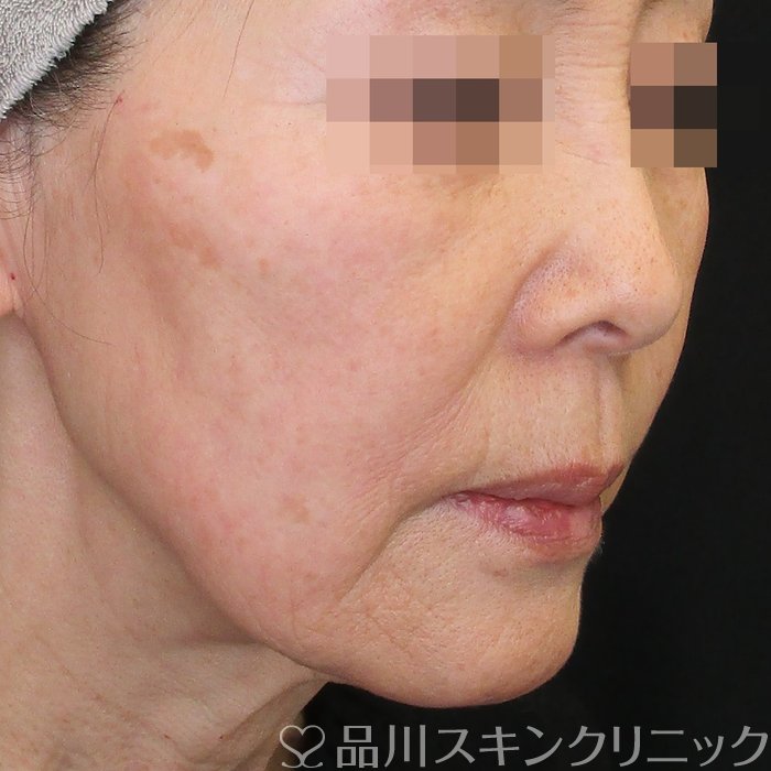 症例NO.73689のBEFORE写真