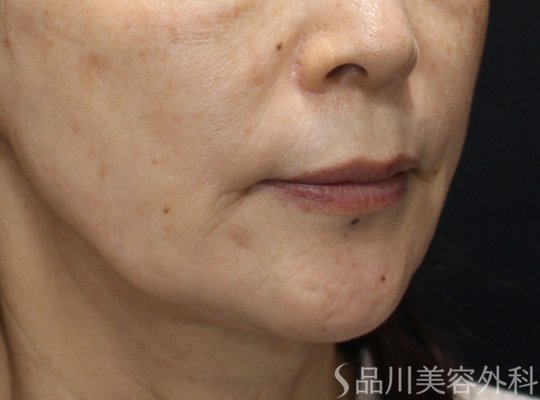 症例NO.75105のAFTER写真