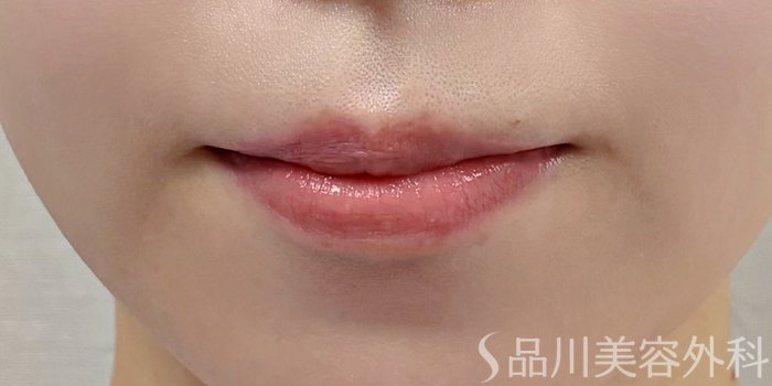 症例NO.70190のBEFORE写真