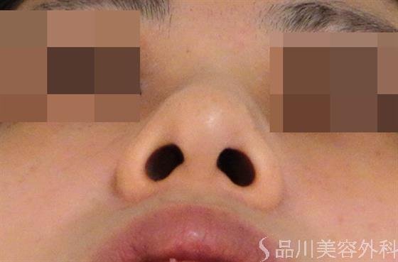 症例NO.39186のBEFORE写真