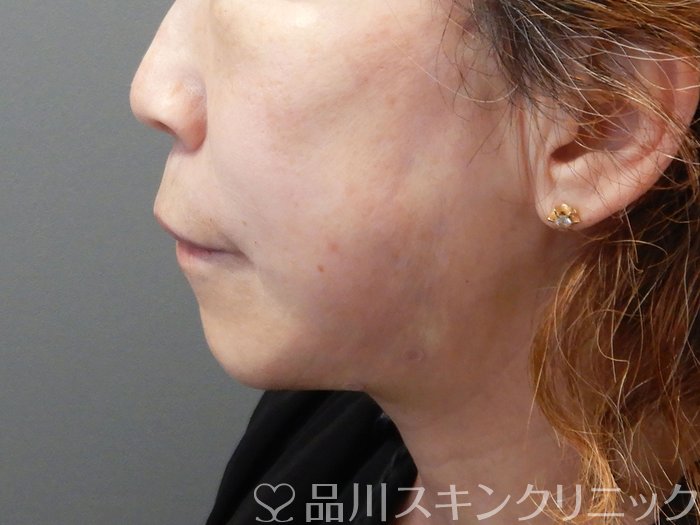 症例NO.72486のAFTER写真