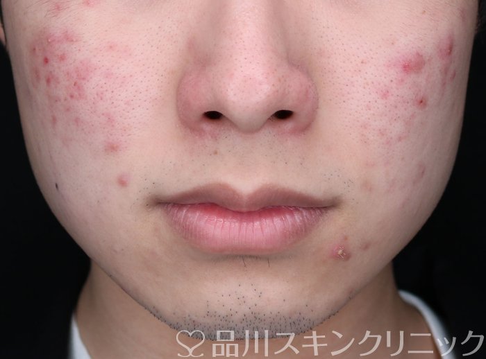 症例NO.73719のBEFORE写真