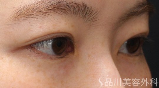 症例NO.74368のAFTER写真