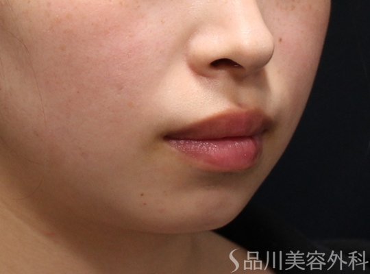 症例NO.73399のBEFORE写真