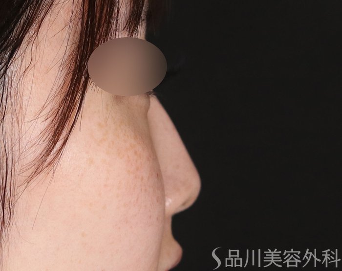 症例NO.74091のBEFORE写真
