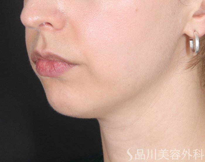 症例NO.73978のBEFORE写真