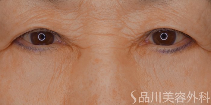 症例NO.69575のAFTER写真
