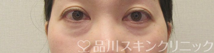 症例NO.69585のBEFORE写真