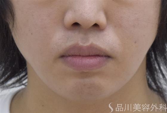 症例NO.47916のBEFORE写真