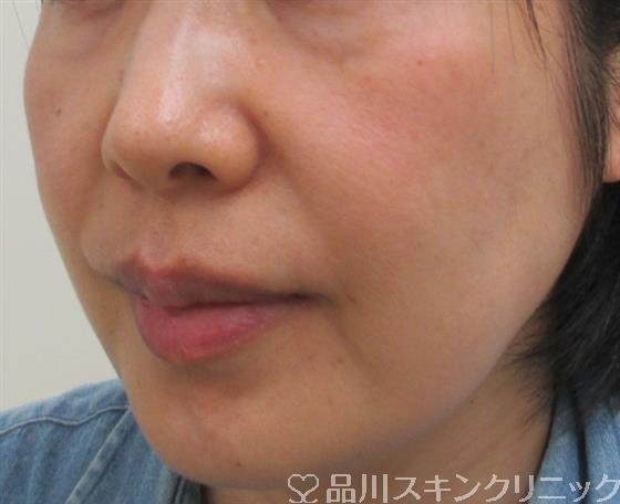 症例NO.25901のBEFORE写真