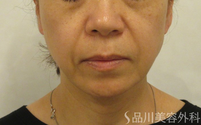 症例NO.72193のBEFORE写真