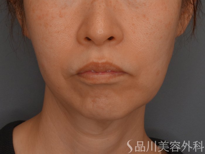 症例NO.65482のBEFORE写真