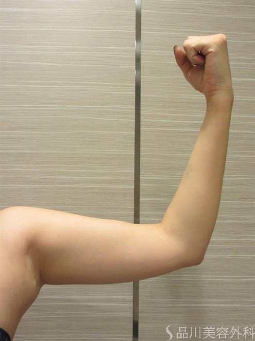 症例NO.24351のAFTER写真