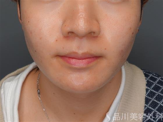 症例NO.56867のAFTER写真