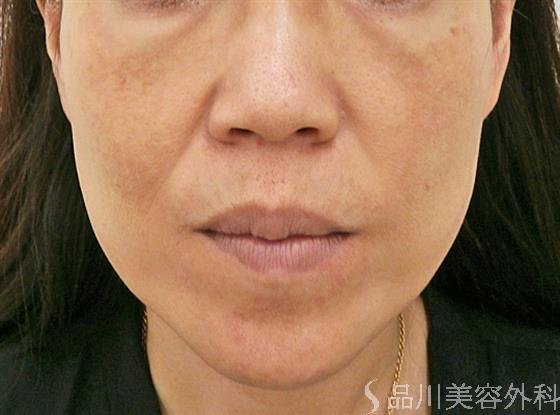 症例NO.32242のAFTER写真