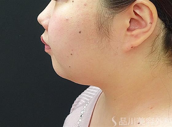 症例NO.40591のAFTER写真