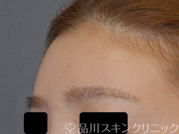 症例NO.72318のAFTER写真