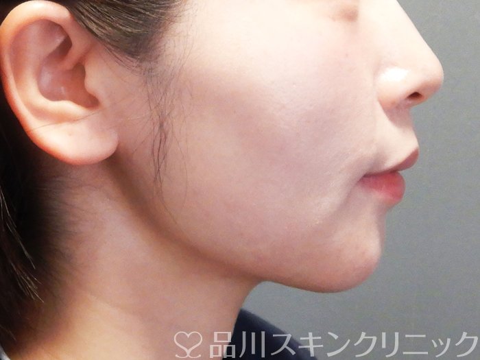 症例NO.73239のBEFORE写真