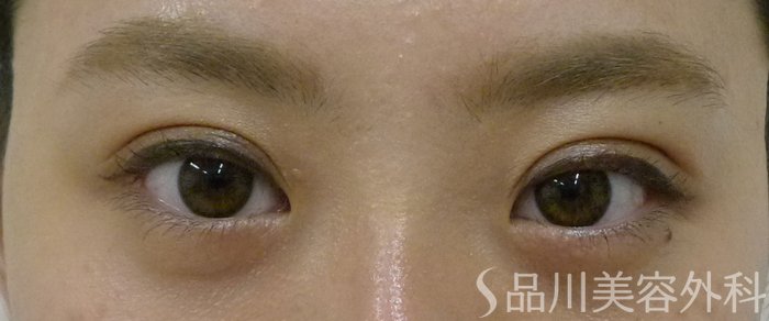症例NO.74159のAFTER写真