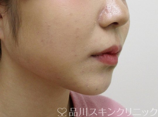 症例NO.65267のBEFORE写真