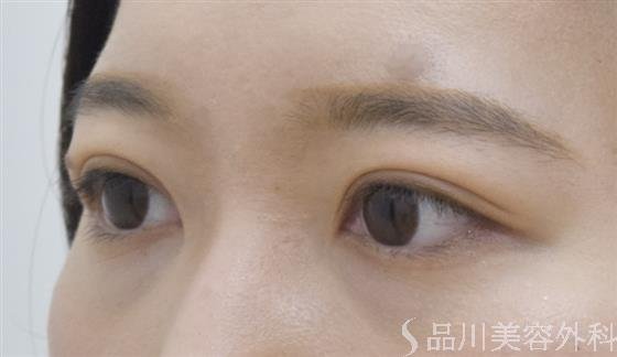 症例NO.54042のAFTER写真