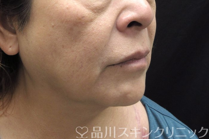 症例NO.74785のBEFORE写真