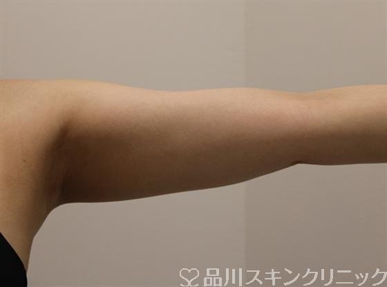 症例NO.47043のAFTER写真