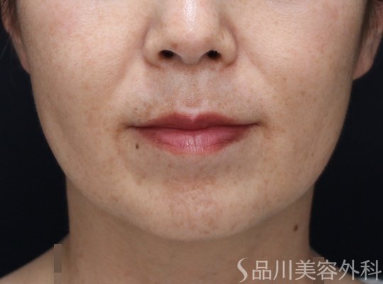 症例NO.73385のAFTER写真