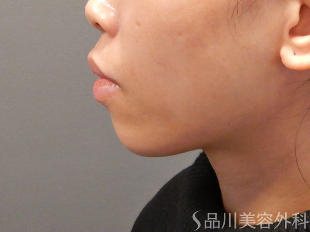 症例NO.73095のBEFORE写真