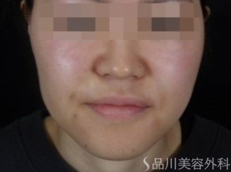 症例NO.73525のAFTER写真