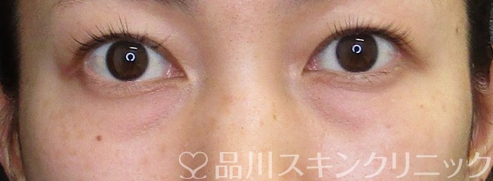 症例NO.63829のBEFORE写真