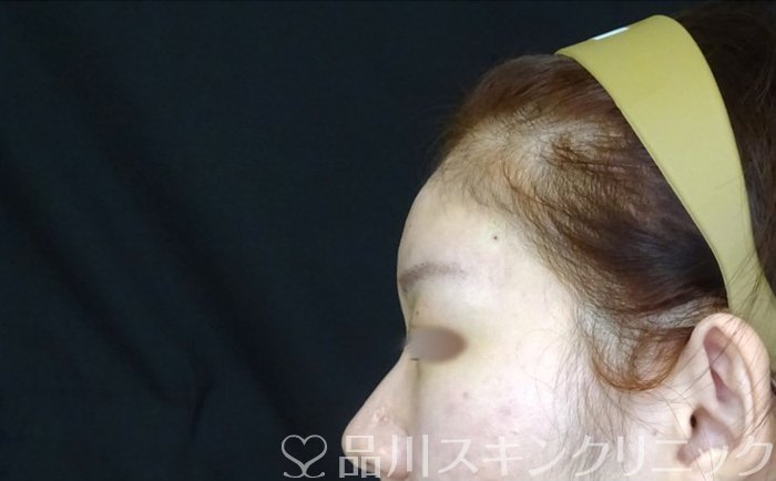 症例NO.72836のAFTER写真