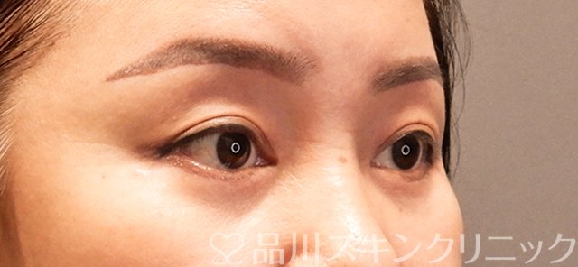 症例NO.71137のAFTER写真