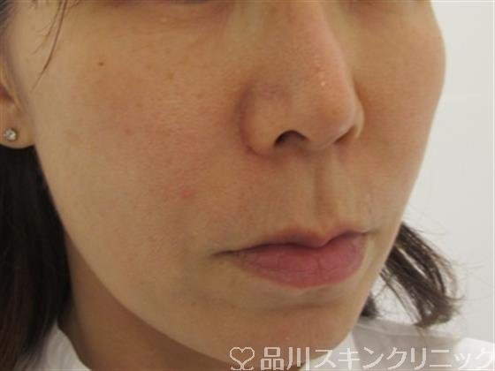 症例NO.33196のBEFORE写真