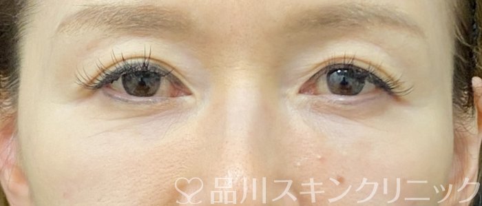 症例NO.75170のAFTER写真