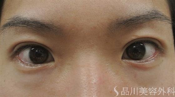 症例NO.16218のAFTER写真
