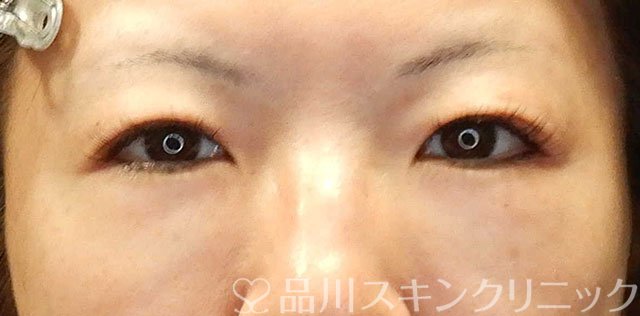 症例NO.65250のBEFORE写真