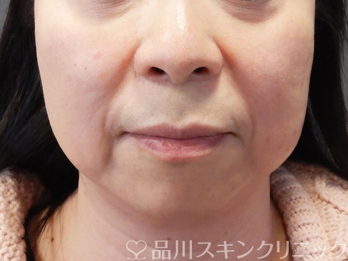 症例NO.72990のBEFORE写真