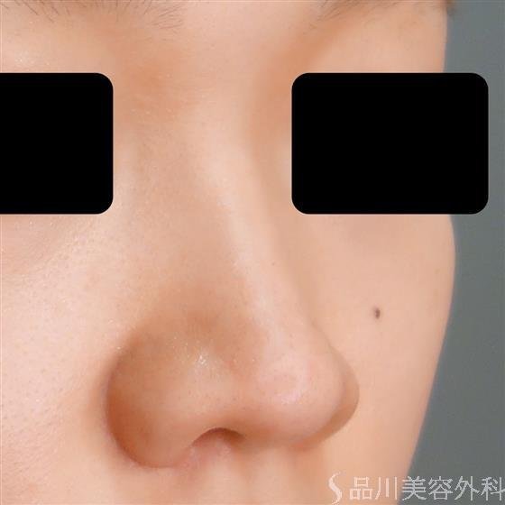 症例NO.54780のBEFORE写真