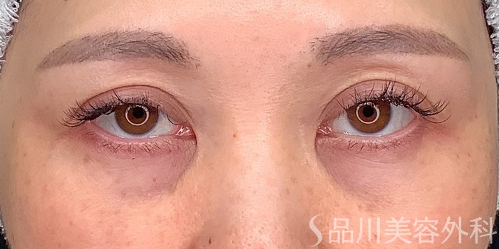 症例NO.71229のBEFORE写真