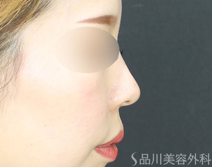 症例NO.71791のBEFORE写真